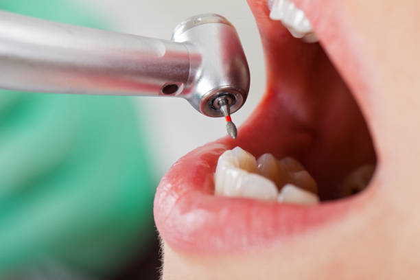 Best Emergency Tooth Extraction in West Haven Sylvan, OR
